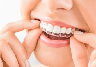 gouttiere-orthodontique-orthodontie-aix-en-provence